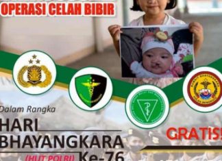 Polda Bengkulu Gelar Operasi Bibir Sumbing Gratis Pada Tanggal 15 Juni