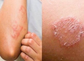 Cara Ampuh Hilangkan Kurap yang Melebar, Gunakan 3 Bahan Alami Ini